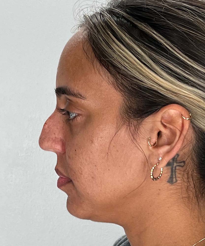 Rhinoplasty Before & After Image